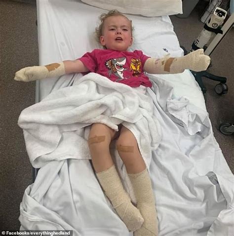 Girl Left With Burns After Falling On A Poorly Extinguished Fire