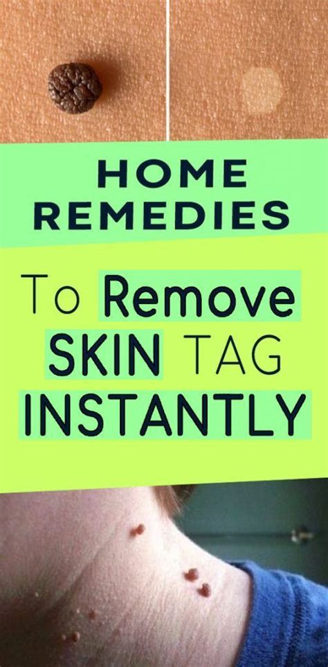 tips to make the most out of your skin remove skin tags naturally