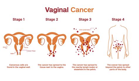 vaginal cancer patient care