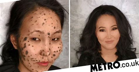 woman born with moles all over her face is transformed into an