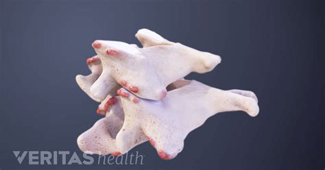 cervical bone spurs symptoms   animation
