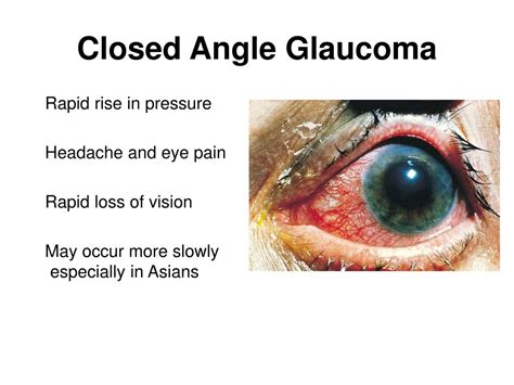 acute angle glaucoma symptoms