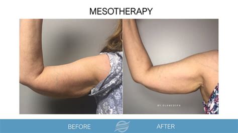 mesotherapy olam med spa