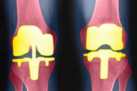 Types Of Bilateral Knee Replacement