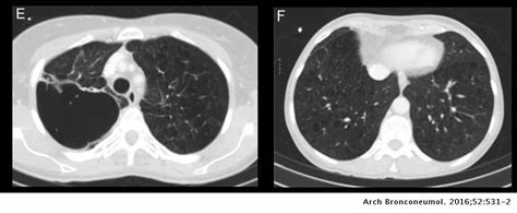 Cavitating Lung Cancer As Response To Bevacizumab Treatment Archivos