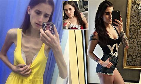 russian teen who weighed five stone beats anorexia daily