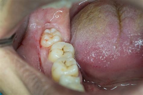 signs  impacted wisdom tooth