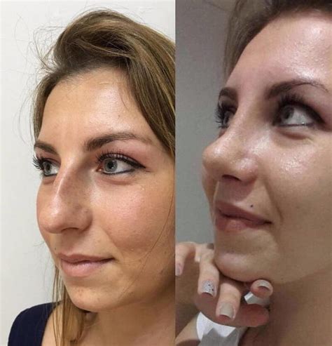 nose jobs  rhinoplasty cost pics reviews qa