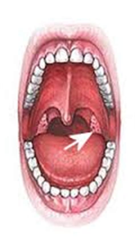 witte stukjes uit keel tips adviezen methodes behandeling voorkomen