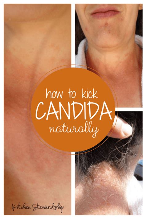 How To Fight Candida Naturally