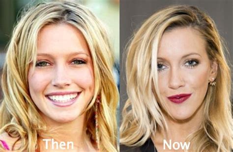katie cassidy plastic surgery before and after photos plastic surgery surgery people