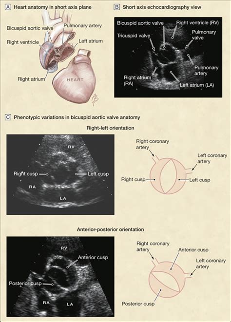 Outcomes In Adults With Bicuspid Aortic Valves Congenital Defects