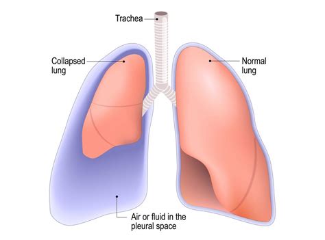 punctured lung pneumothorax symptoms treatment  recovery