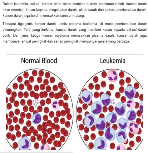 awas sila sebarkan info ini kenali tanda tanda ini di tubuh anda sebelum kanser darah