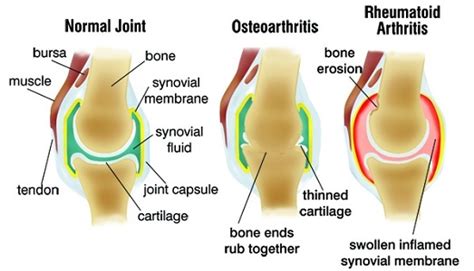 Osteoarthritis Vs Rheumatoid Arthritis Similarities And