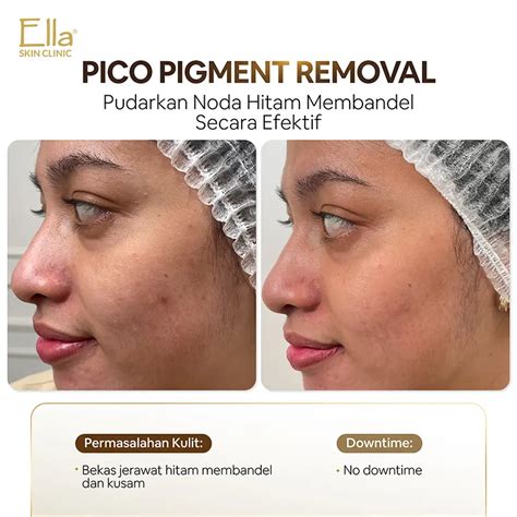 pico laser solusi cepat  kulit sempurna bebas noda ella skin care