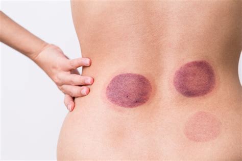 what exactly is cupping therapy and how can it help me