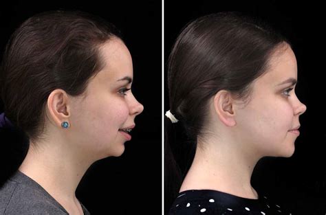 Class Ii Occlusion Anomaly Corrective Jaw Surgery Corrective Jaw