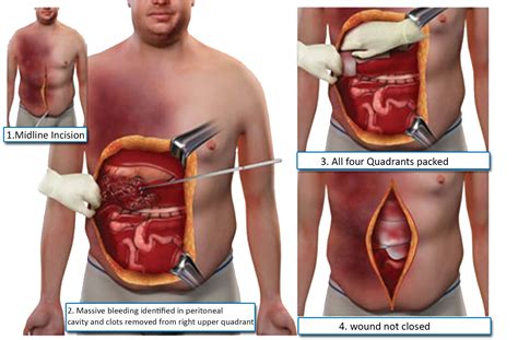 laparotomy  laparoscopy      jalal surgical