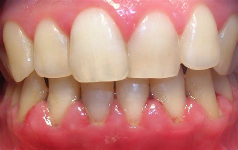 gingivitis american dental  palmdale