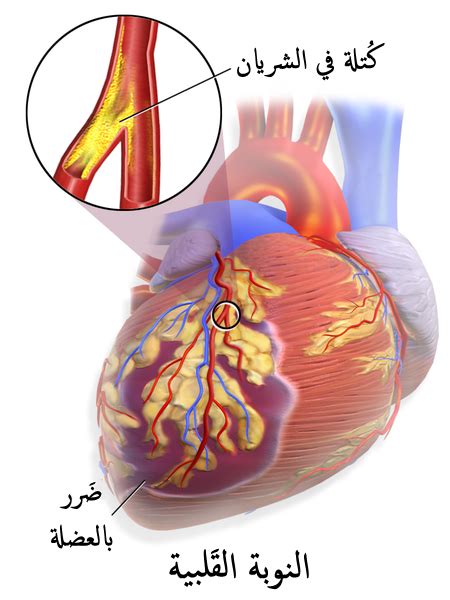 النوبة القلبية امراض القلب والاعشاب