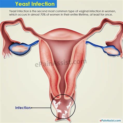 Multiple Vaginal Yeast Infection Best Porno Comments 5