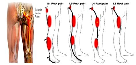 Leg Pain Location And Neurological Signs Relate To Outcomes In Primary