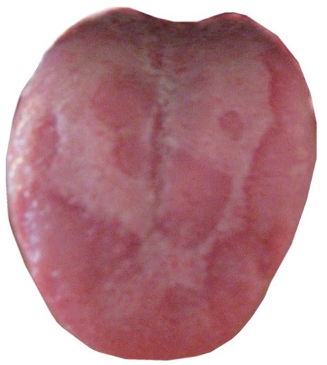 eliminate geographic tongue   youve