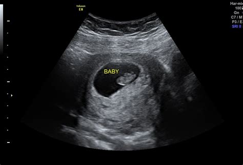 pregnancy verification ultrasounds gender check ultrasound utah