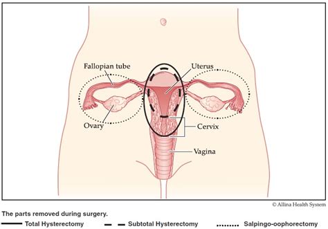 Types Of Hysterectomy Surgery Hysterectomy Surgery Allina Health