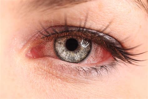pink eye symptoms  shouldnt ignore  healthy