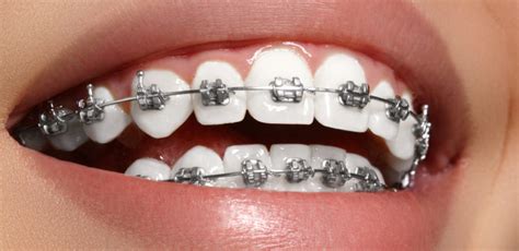 Going Back To School With Braces 5 “metal Mouth” Myths You Can Bust