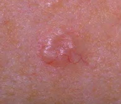 fresh faced skin care skin cancer affects