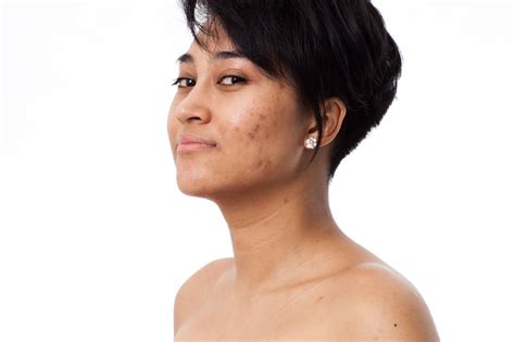 treatment  dark spots   face tonique skincare
