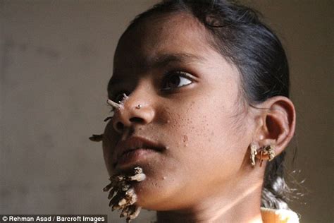 Girl Has Developed Roots On Her Cheeks And Chin Daily