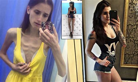 russian teen who weighed five stone beats anorexia daily