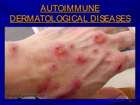autoimmune skin disease