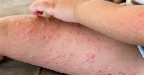 hand foot and mouth disease spreading in tampa