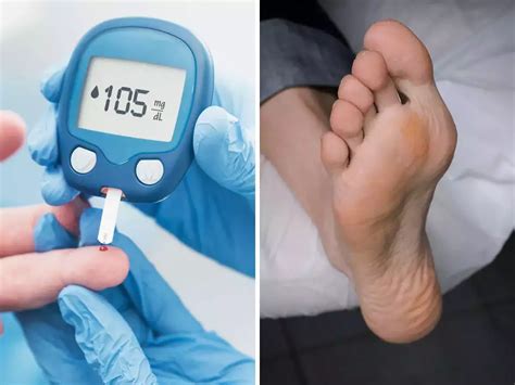 diabetes symptoms   feet  signs   high blood