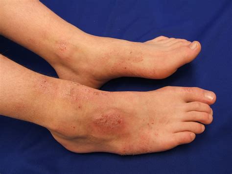 atopic dermatitis symptoms  treatment triggers