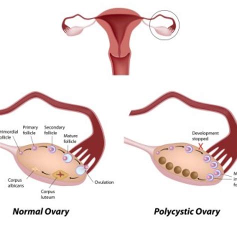 what causes pcos pcos tests toronto naturopath