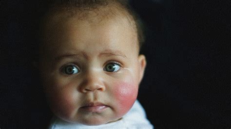 rosy cheeks   baby   treatments