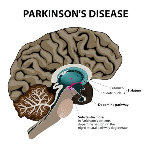 blood letting  brain stimulation  years  parkinsons
