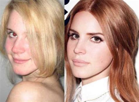Lana Del Rey Plastic Surgery Lip Filler Nose Job Breast
