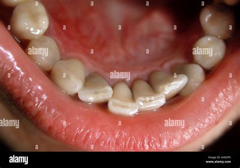 close   rows  teeth tooth     mouth stock photo