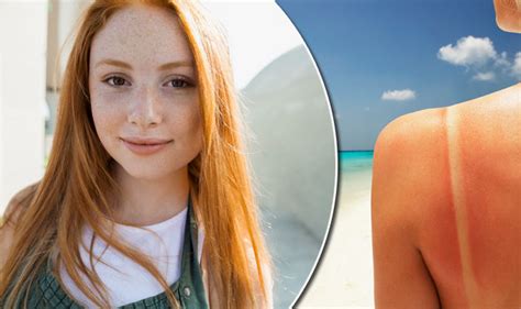 scientists confirm red heads are more likely to get skin
