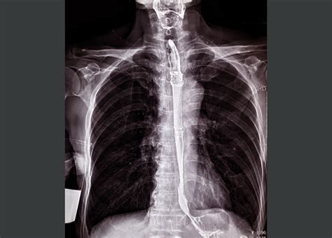 stenting   fully resolve refractory esophageal strictures