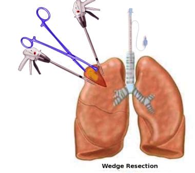 lung segmentectomy  limited pulmonary resection technique