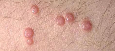 causes and cures for itchy vaginal lumps bumps and sores