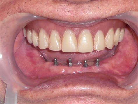 dental implantology   upper full denture stabilization procedure secrets revealed